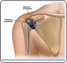 Shoulder Arthroscopy